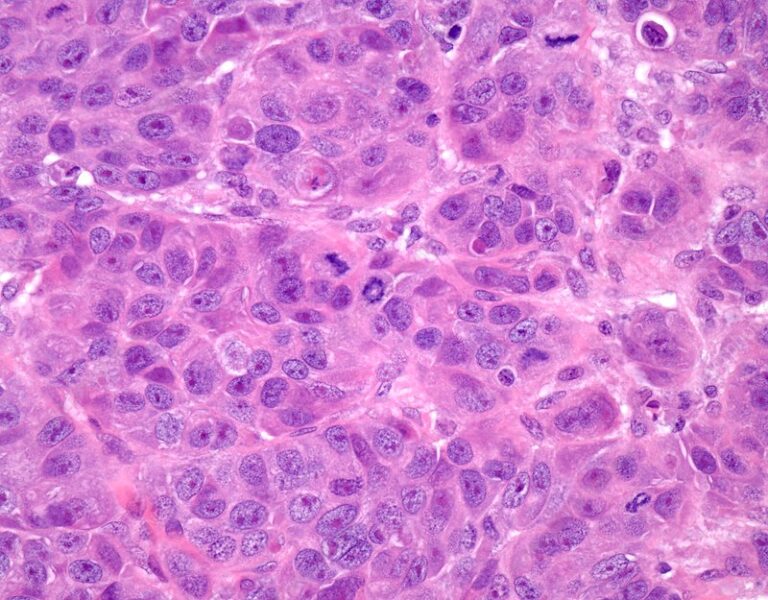 Study finds lower sexual and psychosocial well being among young women who opt for mastectomies