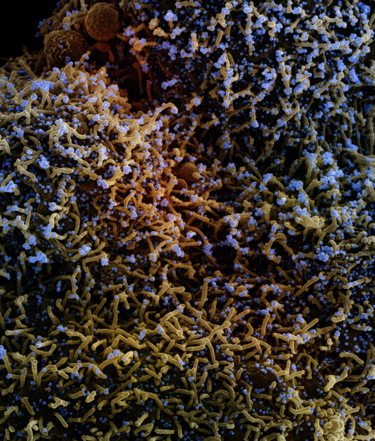 Lung autopsies of COVID-19 patients may offer treatment clues