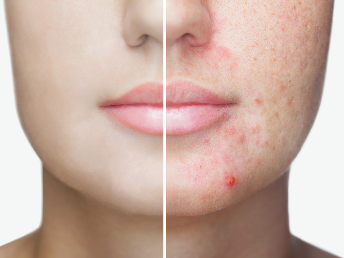 New acne treatment 'exciting' but Europe will have to wait